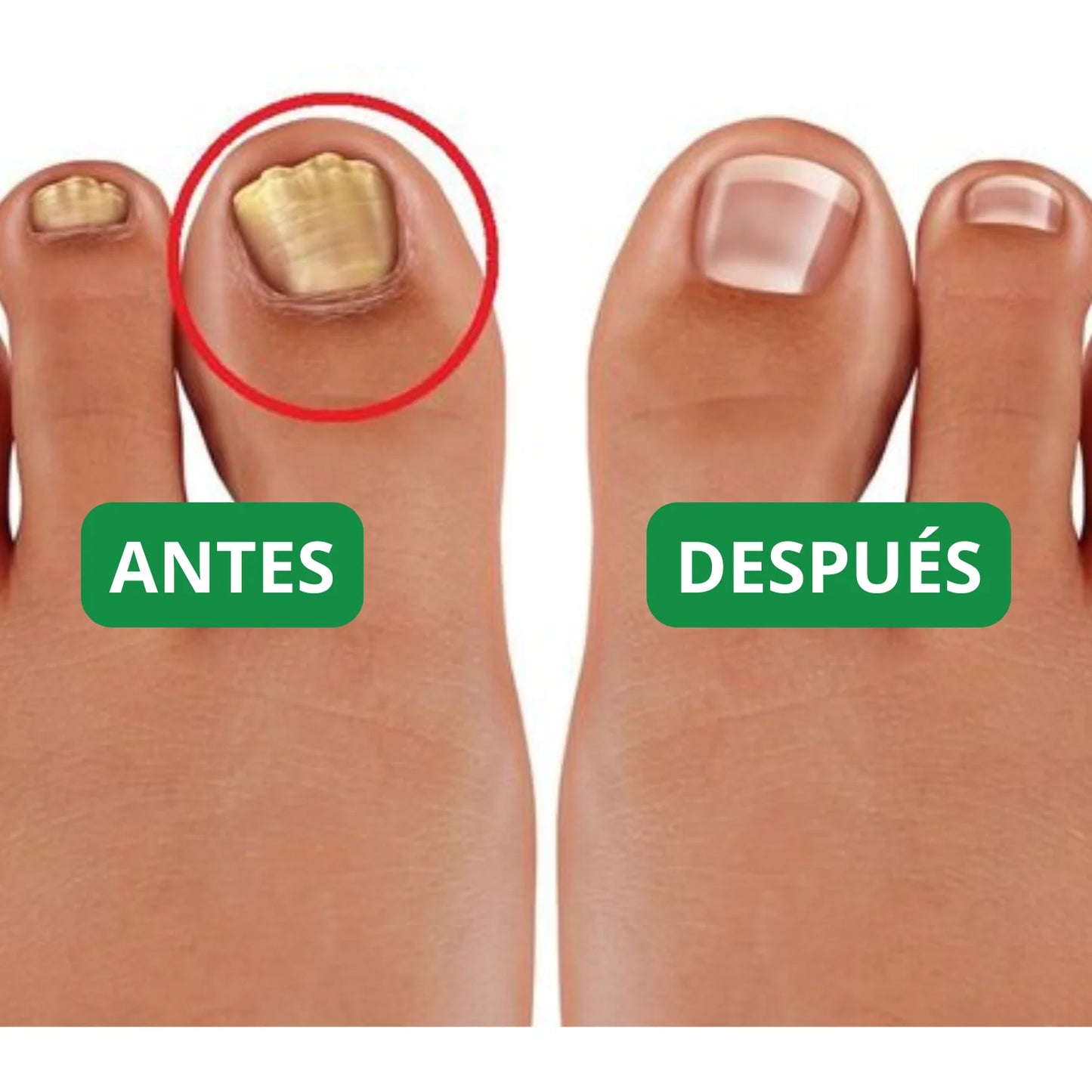 NailRestore™ - Di adiós al dolor y las uñas encarnadas