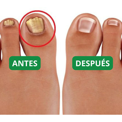 NailRestore™ - Di adiós al dolor y las uñas encarnadas